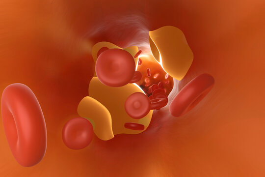 Three dimensional render of artery clogged by cholesterol