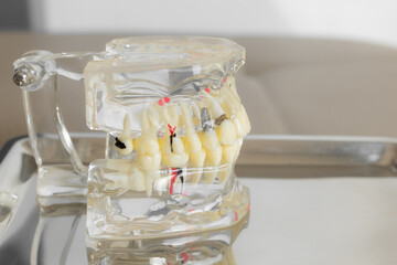 orthodontic model and dentist tool - demonstration teeth model of varities of orthodontic bracket...