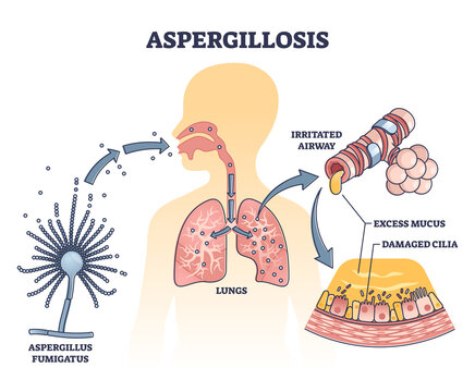 Aspergillosis lung infection caused by Aspergillus, vector outline diagram.Irritated airway, excess mucus and damaged cilia caused by common mold fungus spores.Microbiological danger for human health.