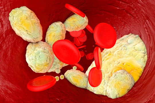 3D Rendered Illustration, visualisation of fat clogging a artery and forming the sickness arteriosclerosis