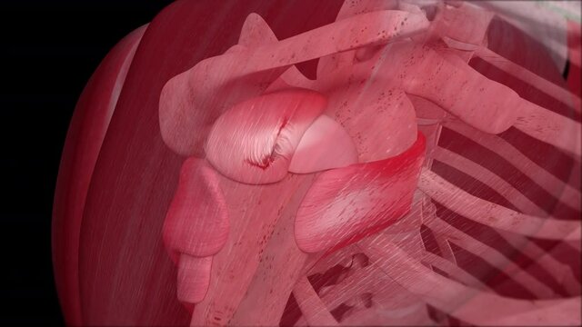 Shoulder Injury with L Shaped Tear of the Rotator Cuff