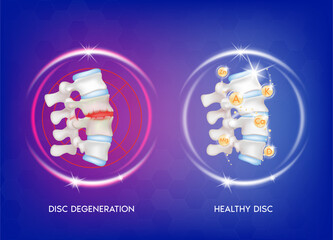 Spine disease, normal backbone, degenerative disc and herniated disc. Skeleton x ray scan concept and Vitamin therapy. Human vertebrae anatomy. Medical flat vector illustration