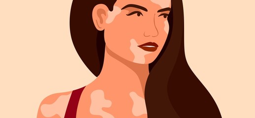 Vitiligo is a young woman with skin problems. Skin diseases. The concept of World Vitiligo Day. Different skin colors of female characters. For a blog, articles, banner, magazine.