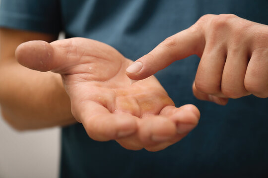 Man applying cream on hand for calluses treatment against grey background, closeup