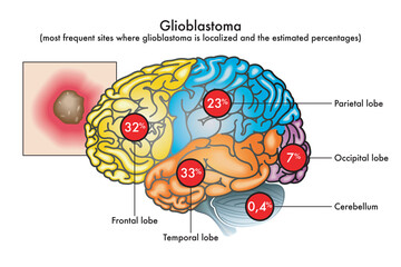 Medical illustration of most frequent sites where glioblastoma is localized in the brain and the estimated percentages. - obrazy, fototapety, plakaty