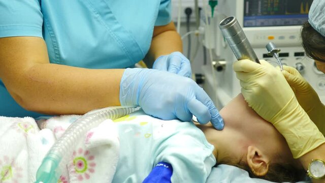 Tracheal intubation on kid patient in resuscitation. Anesthesiologist doctor insets endotracheal tube before surgery operation. Intubation procedure. Preparation for general anesthesia. 4 k video