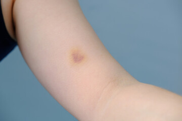 close-up female hand with darkened bruise on delicate skin, shoulder injury, life safety concept, physical abuse