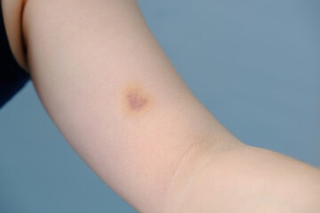 Fototapeta premium close-up female hand with darkened bruise on delicate skin, shoulder injury, life safety concept, physical abuse