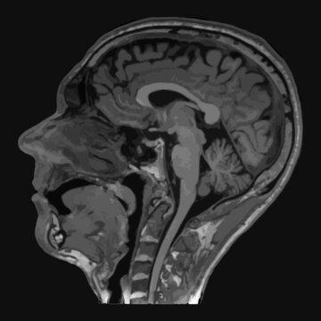 Realistic image sagittal of male head with CT scan, MRI Magnetic resonance imaging layer of head. Isolated on dark background. Vector illustration.