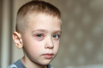 Boy swollen red eye allergy. Portrait of Caucasian upset child looking at the camera. Inflammation...
