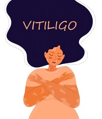 Vitiligo concept vector. World vitiligo day illustration. Disease of the skin and dermatological problems.