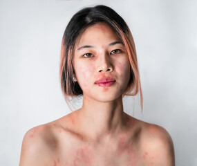 Asian woman suffering from Skin allergy from Cosmetic and Make up making her skin all over the body...