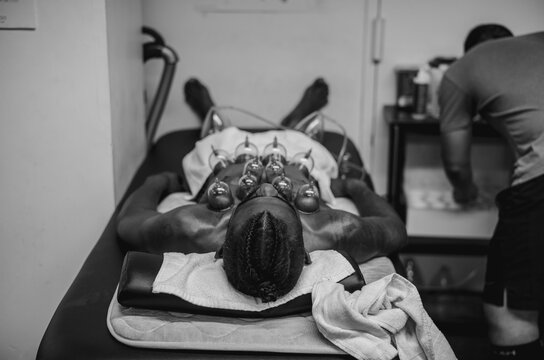 cupping 