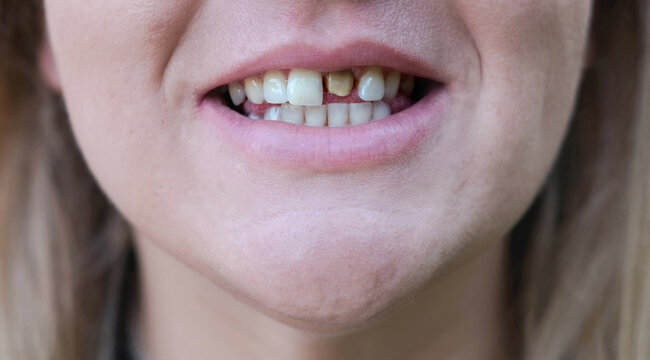 Woman's smile with a bad tooth. Teeth before treatment. Close-up.