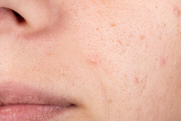 acne on a woman face, white and black pimples on the girl skin
