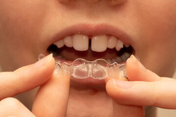 Close up of a girl holding put on invisible braces. Orthodontic dental braces teeth straighteners. Gap between front teeth