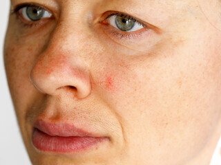 Fototapeta premium Cuperosis on the cheek of middle aged woman. Rosacea acne on the face. Erythrosis rosacea