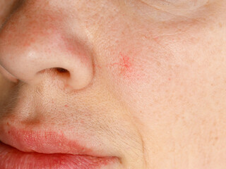 Cuperosis on the cheek of middle aged woman. Rosacea acne on the face. Erythrosis rosacea close up