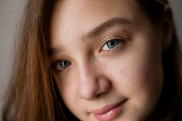 Obraz premium Face of a teenage girl in close up. Teen with problematic skin. Girl with a square hairstyle. Acne and scars. Natural portrait. No makeup and retouch. High quality photo