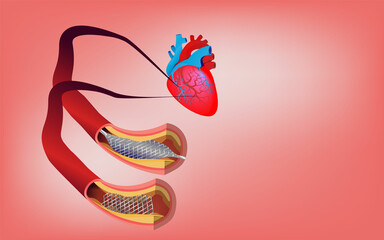 Stent implantation for heart coronary. Coronary artery bypass surgery. heart bypass surgery. Heart and heart attack. - obrazy, fototapety, plakaty