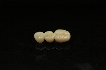 Long Zirconia bridge with all porcelain baked. PFM bridge. Dental technician 's works