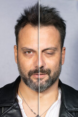 Effects before and after a facial paralysis - obrazy, fototapety, plakaty