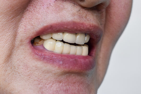 Zirconia Crowns of Front Teeth