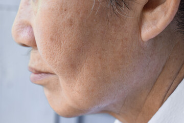 Enlarged pores in face of Asian, elder man with skin folds.
