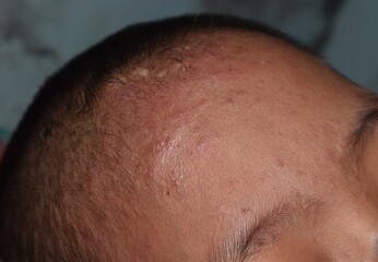 Fototapeta premium Small skin lesions on forehead