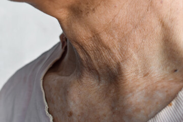 Aging skin folds or skin creases or wrinkles at neck