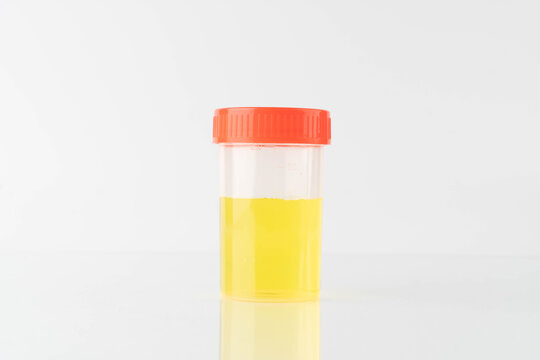 Yellow color urine sample bottle for check signs of common conditions or diseases on white background.