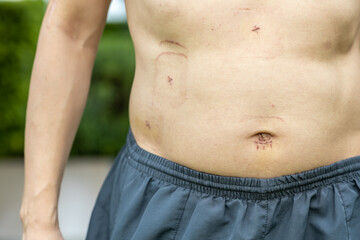 Naklejka premium Small wounds from Laparoscopic Cholecystectomy Man get Gallstones and patient get Gallbladder surgery by Laparoscopic Cholecystectomy Doctor remove gallbladder because get gallstone Get quick recovery