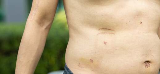 Small wounds from Laparoscopic Cholecystectomy Man get Gallstones and patient get Gallbladder...