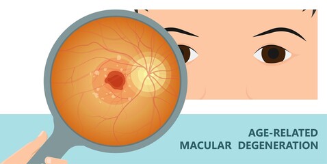 macular degeneration hemorrhage dry wet Age hole pucker edema eye vision loss AMD retina drusen blind spots Blood vessels leak blurry adult lose visual field exam treat contact lens myopia older tear