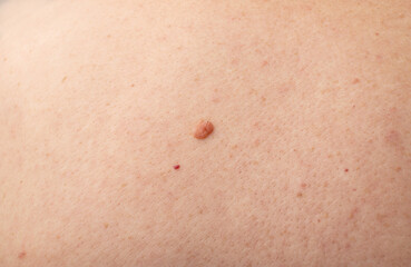 Fototapeta premium Skin mole closeup. Macro photo of blemish similar to melanoma