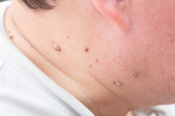 Papillomas on a person's neck.Human skin disease.
