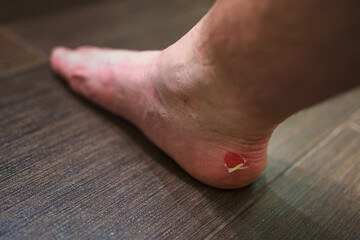 A punctured blister on the heel of a man's foot caused by forceful rubbing.