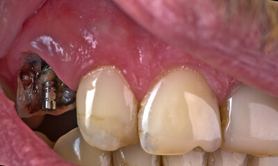 A missing tooth and a stent screwed into its place closeup.