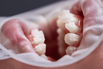 Close up of person with opened mouth and white teeth with orthodontic braces. Patient with cheek...