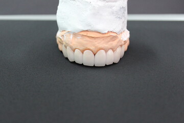A dental  bridge made of zirconia material that is made by a technician for the dentist to put on the patient.
