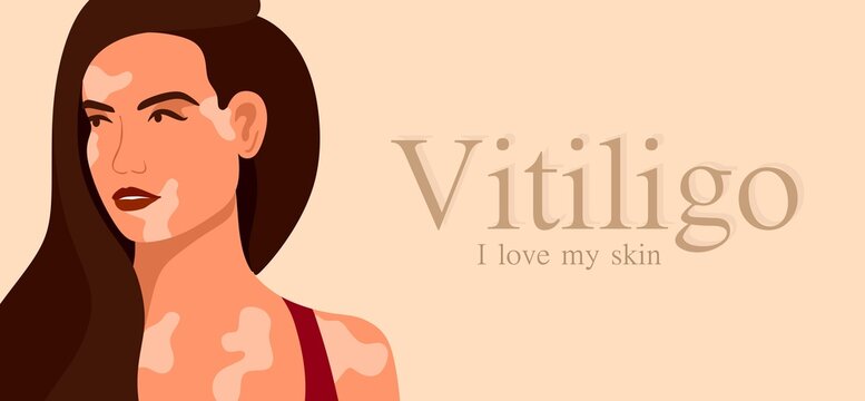 Vitiligo is a young woman with skin problems. Skin diseases. The concept of World Vitiligo Day. Different skin colors of female characters. For a blog, articles, banner, magazine.