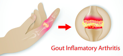 Illustration of Gout disease in Human, Auto immune disorder in humans. joint pain.Medical illustration of the symptoms of gout.