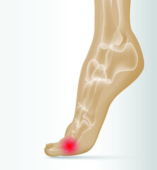 Illustration of Arthritis  joint . Rheumatoid arthritis. Pain in leg. Human bone anatomy flat vector illustration. Painful injury erosion on a white background.