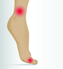 Illustration of Arthritis  joint . Rheumatoid arthritis. Pain in leg. Human bone anatomy flat vector illustration. Painful injury erosion on a white background.