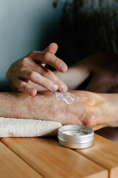 Man with psoriasis disease applying body cream