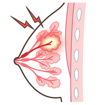 45 Best 乳腺症 Images Stock Photos Vectors Adobe Stock