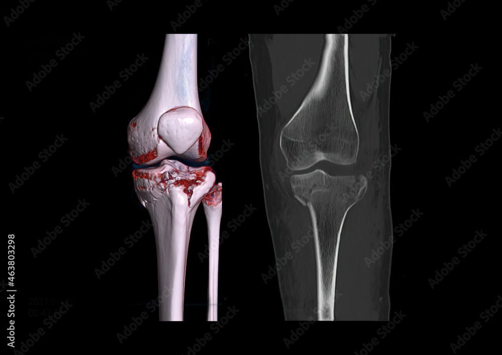 Poster compare of ct knee joint 3d rendering image and ct knee 2d coronal view isolated on black background