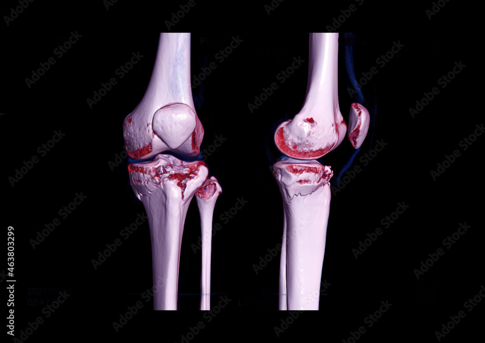 Poster compare ap and lateral view of ct knee joint 3d rendering image showing fracture tibia bone.