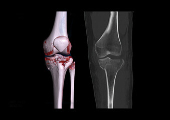 Compare of CT knee joint 3D rendering image  and CT knee 2D Coronal view isolated on black background showing fracture tibia bone.