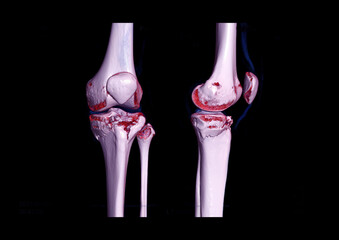 Compare AP and lateral view of CT knee joint 3D rendering image  showing fracture tibia bone.